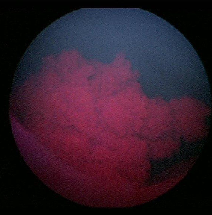 Derselbe Blasentumor unter Blaulicht in der fluoreszenzgestützten Blasenspiegelung, das Tumorgewebe leuchtet rot