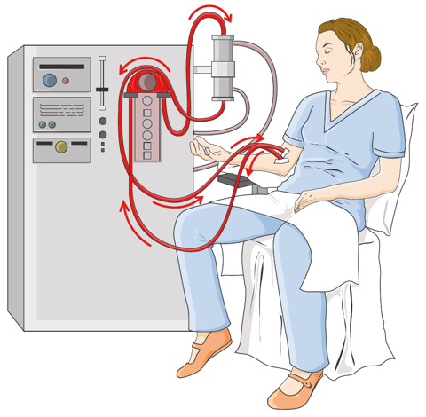 Schema einer Dialysebehandlung