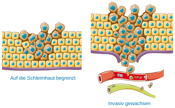 Oberflächliches und invasives Wachstum