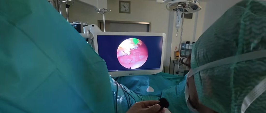 Blick auf den Monitor während einer Prostata-Ausschälung