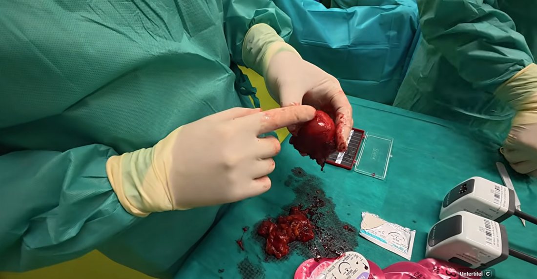 Entfernte Prostata in der Hand des Operateurs